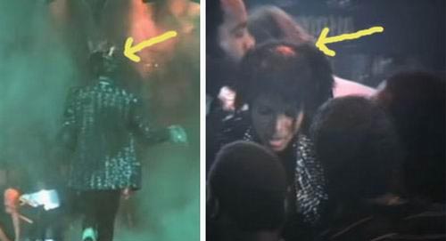 杰克逊头顶有一大块头发已被烧光，露出红红的头皮。