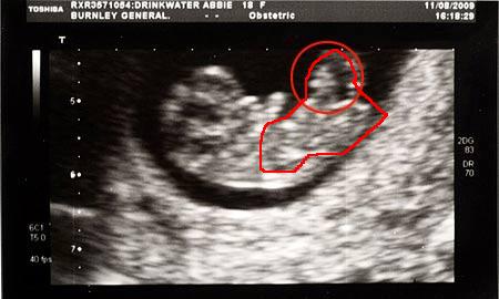 abbie-drinkwater-s-baby-scan-pic-jeff-morris-image-1-609873873.jpg